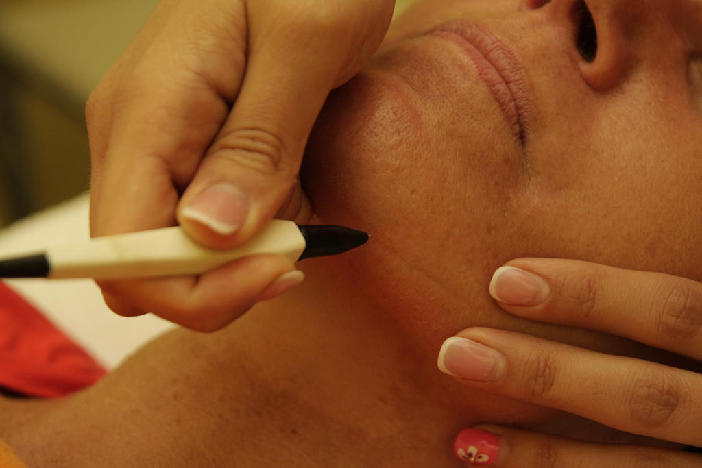 elektroepilation an Kinn, weisse bürstige haare ist nur mit elektroepilation möglich zu entfernen